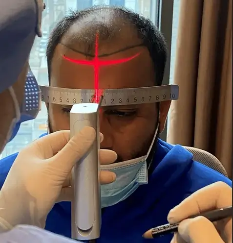 Laser Hairline Tool Before Surgery