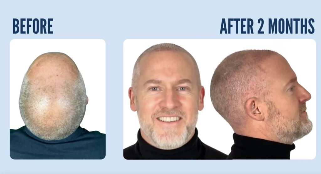 C.A. before and 2 months after a 5500 grafts combination hair transplant.