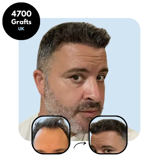 Combination Hair transplant results 4700 grafts