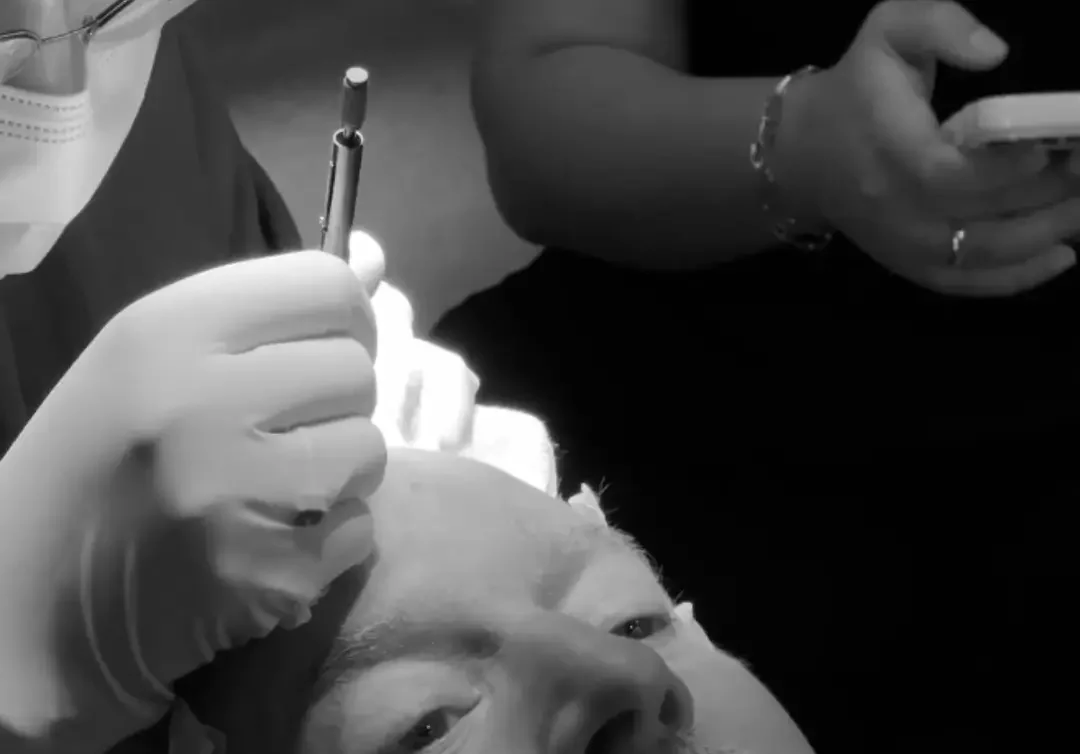Combination-Surgery-Hairline-and-Alopecia-e1738227328900
