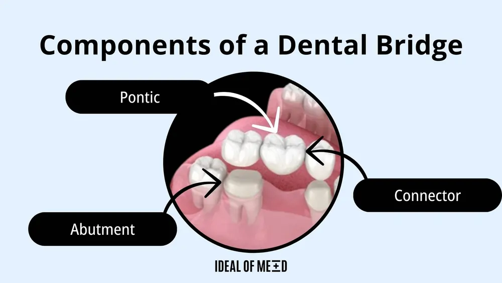 Components of a Dental Bridge