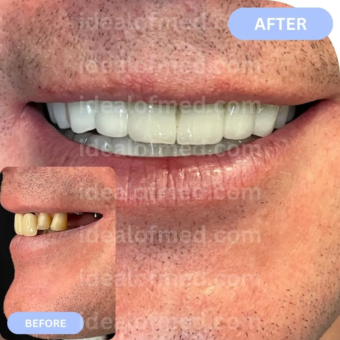 Dental Implants in Turkey