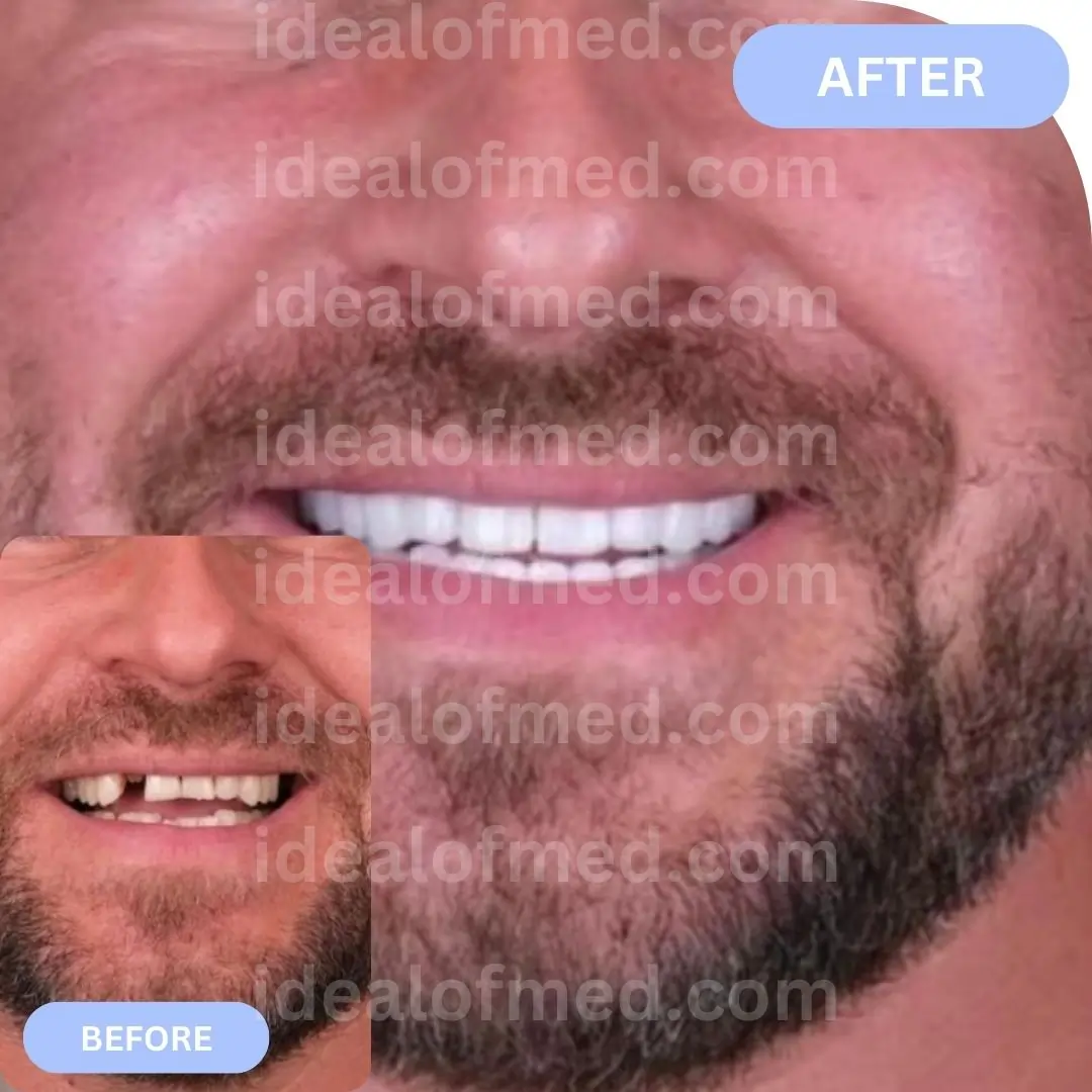 Dental implants in Turkey