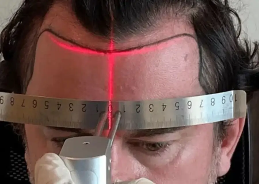Drawing hair line before hair transplant