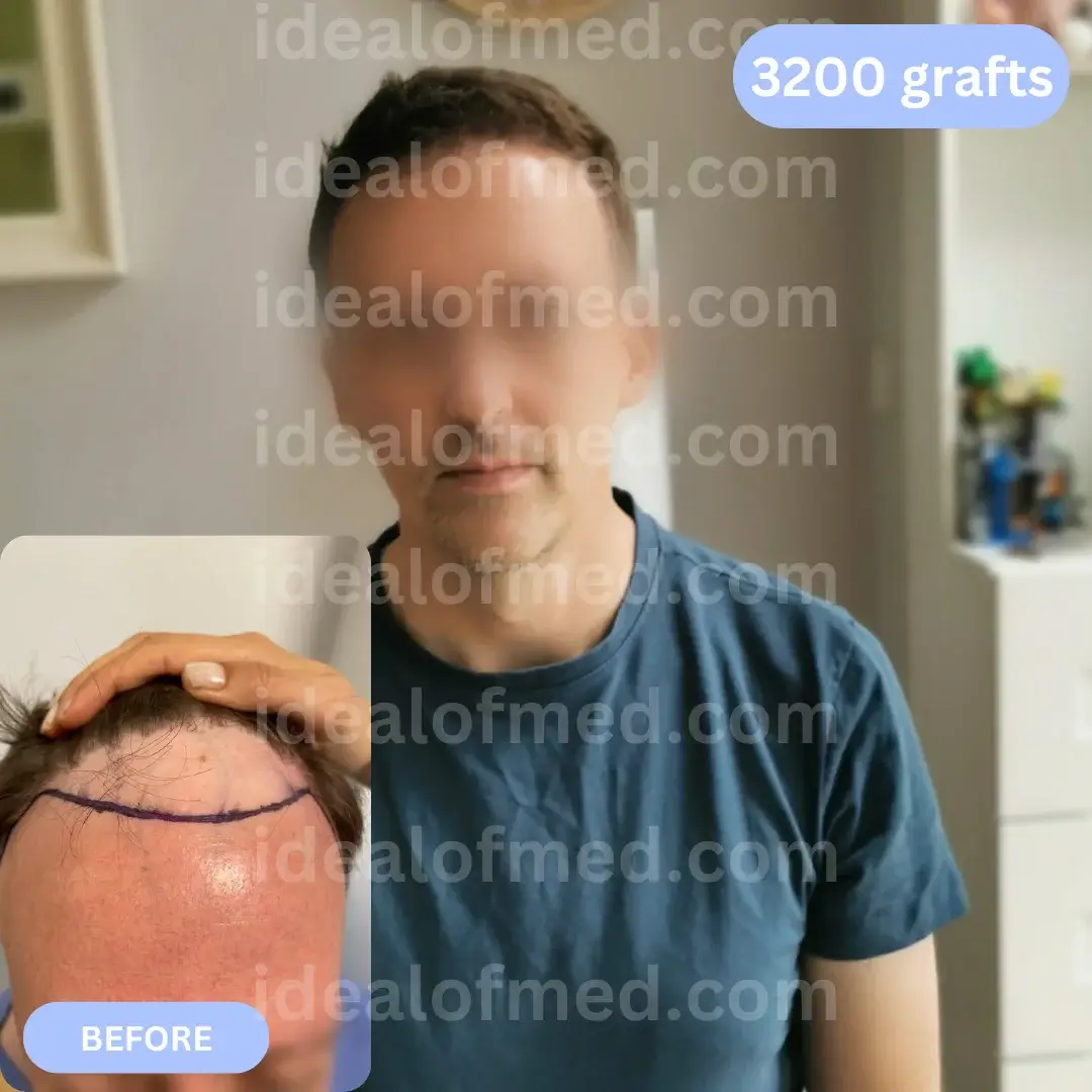 D.R. (41) from Ireland after hair transplant 12 months (FUE 3200 grafts)