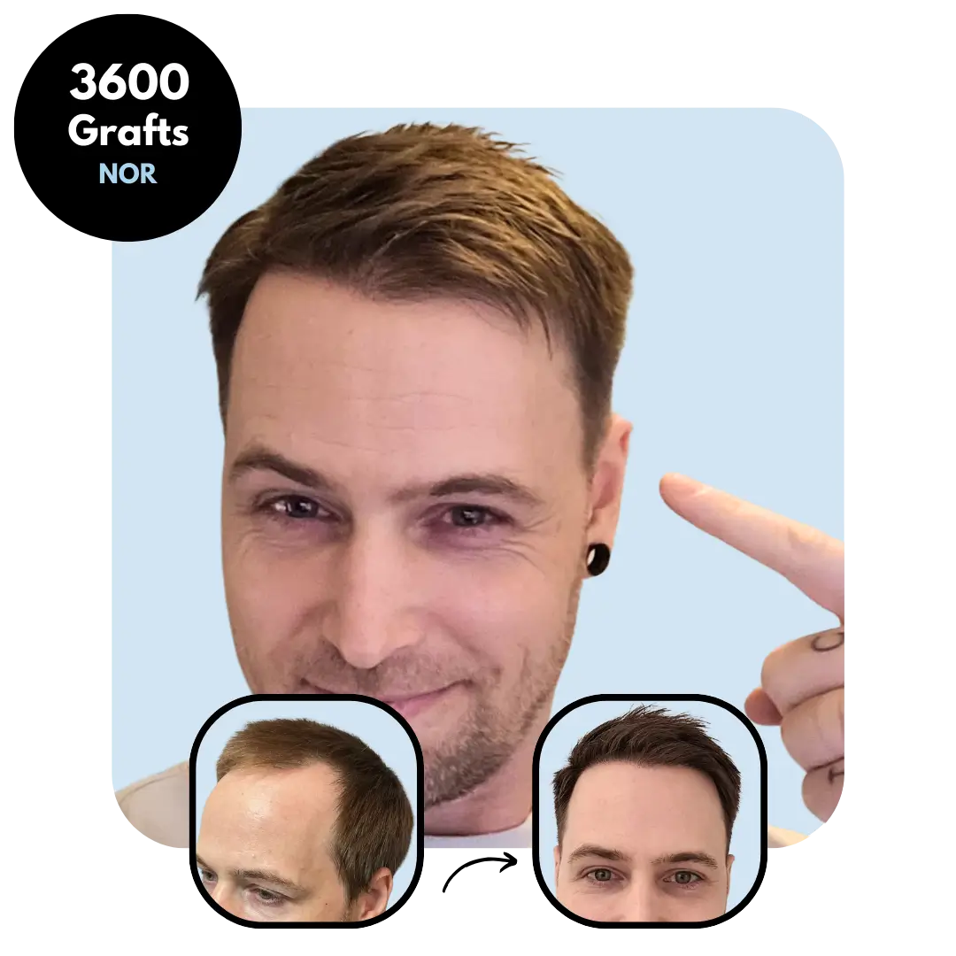 DHI Hair transplant results 3600 grafts