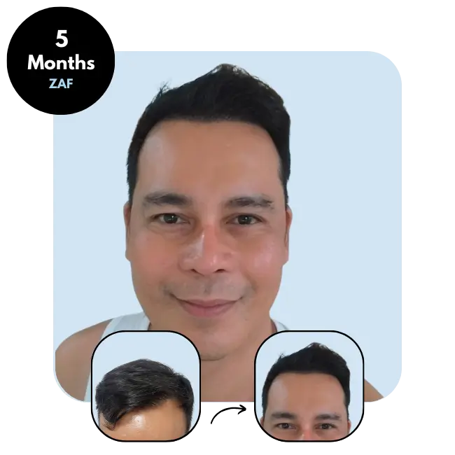 E.C. (49) from South Africa hair transplant after 5 months (3700 grafts DHI)