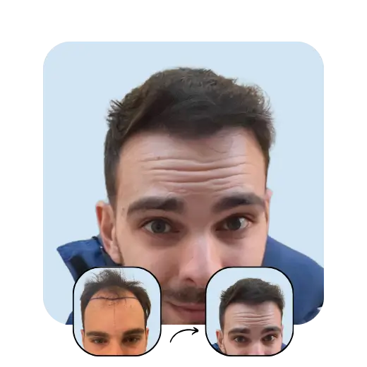 E. B. post hair transplant. Before and after 1 year.