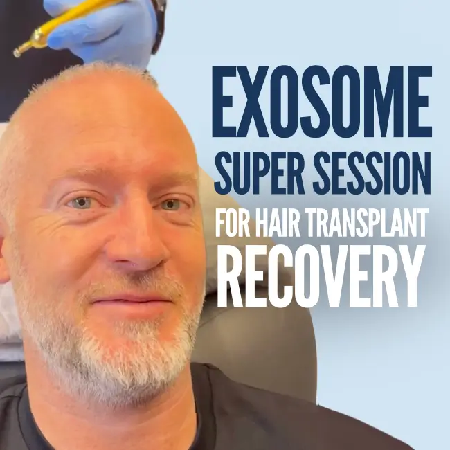 Exosome Treatment for Hair Transplant Recovery | Exosome Super Session