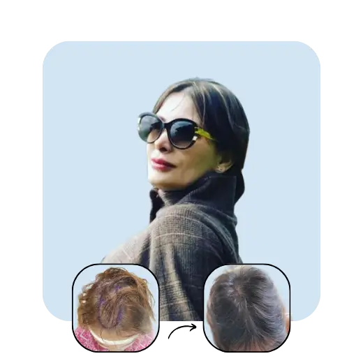 F. S Female hair transplant after 1 year
