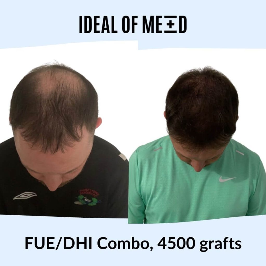 FUE/DHI Combo, 4500 grafts