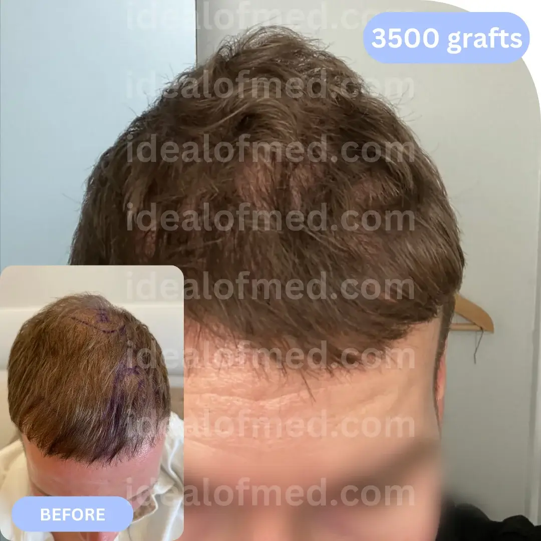 H.H. (36) from Finland after hair transplant 12 months (DHI 2600 grafts)