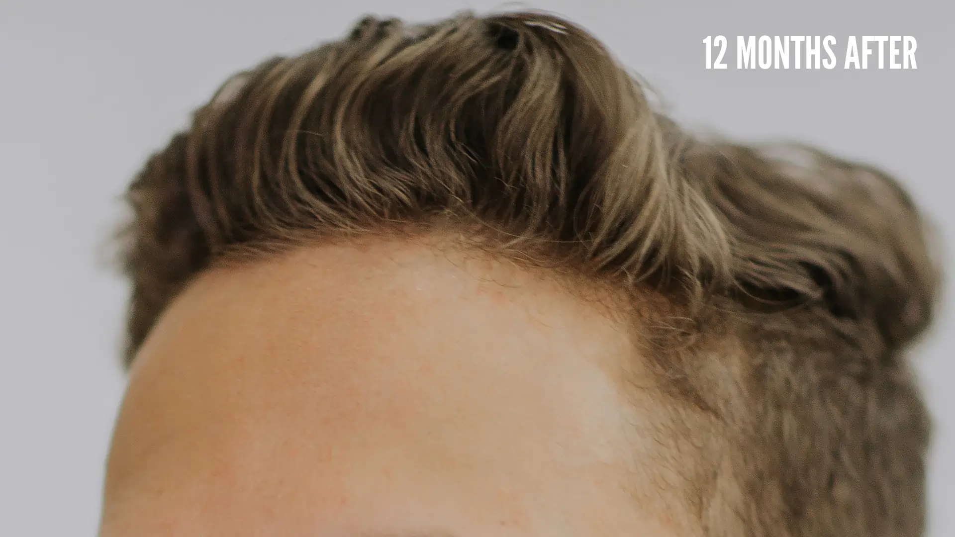 Hair Transplant Growth Timeline 12 Months after hair restoration surgery