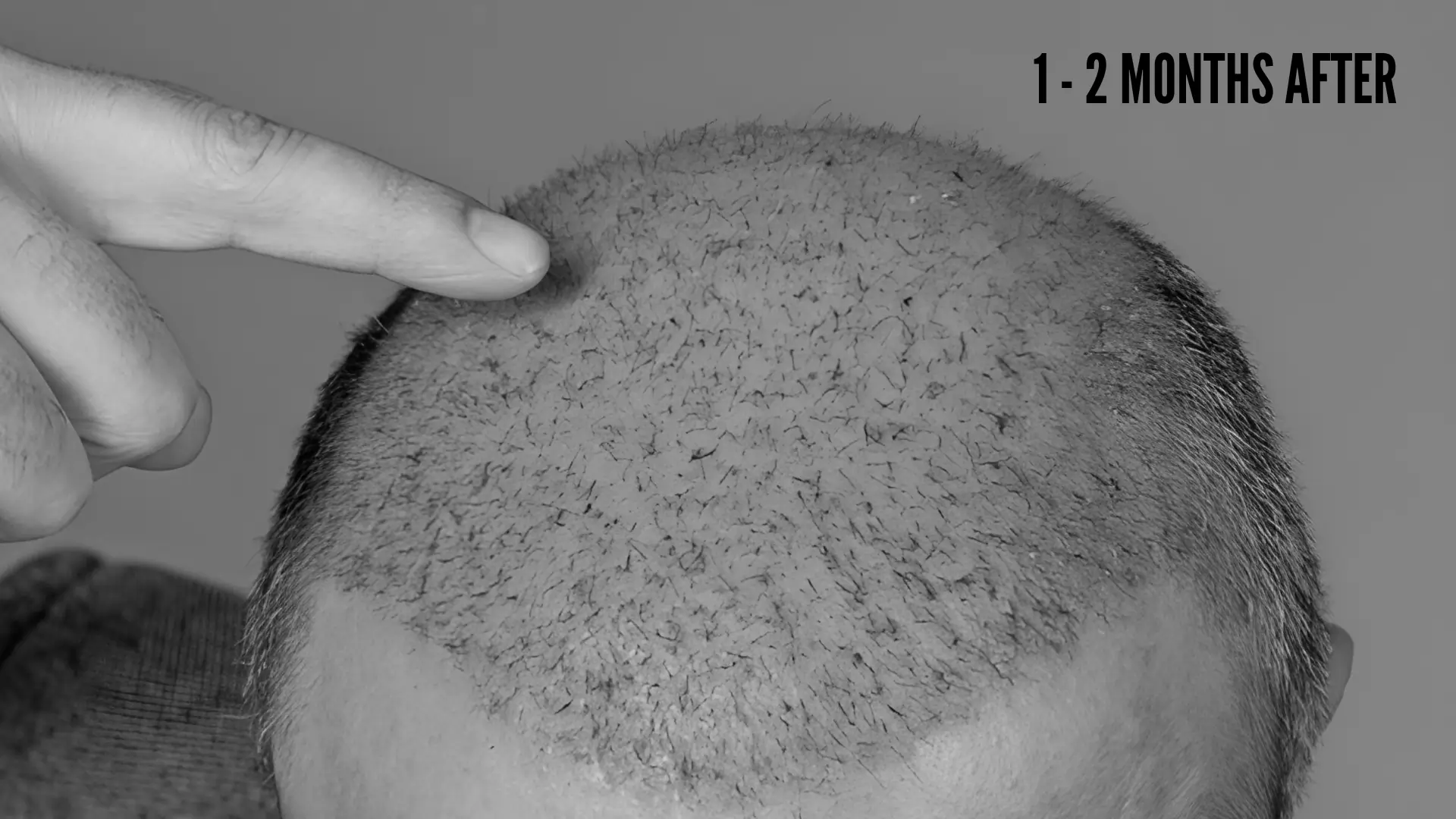 Hair Transplant Growth Timeline Months 1 – Month 2 after hair restoration surgery