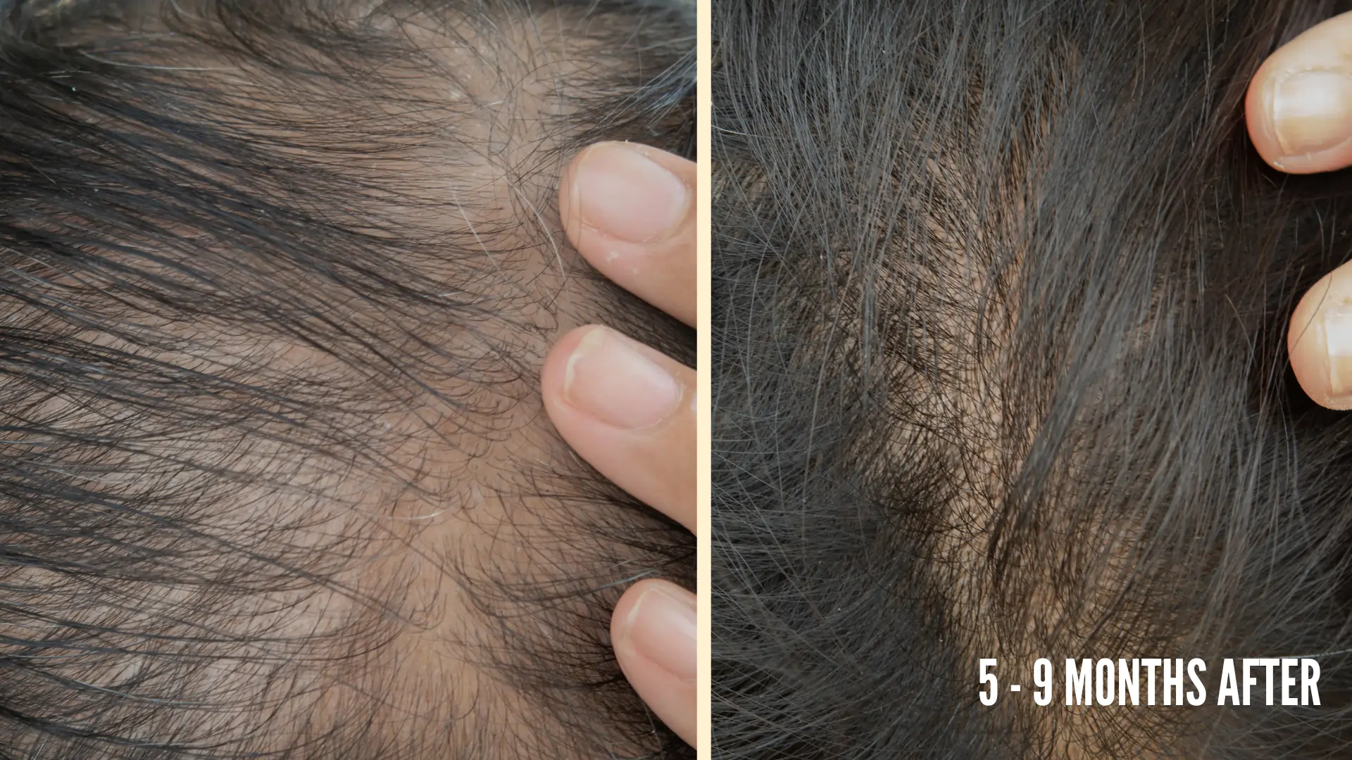 Hair Transplant Growth Timeline Months 5 – Month 9 after hair restoration surgery