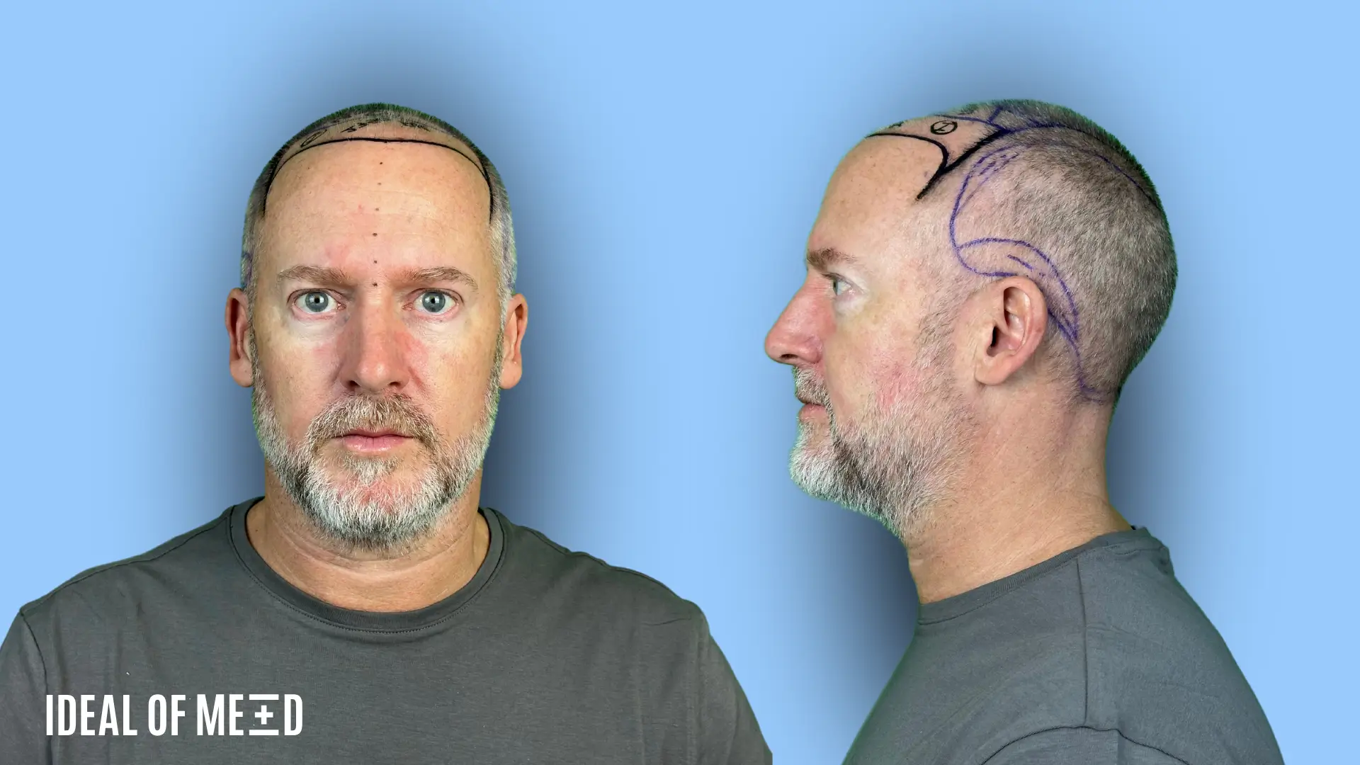 Hair Transplant Hairline Design