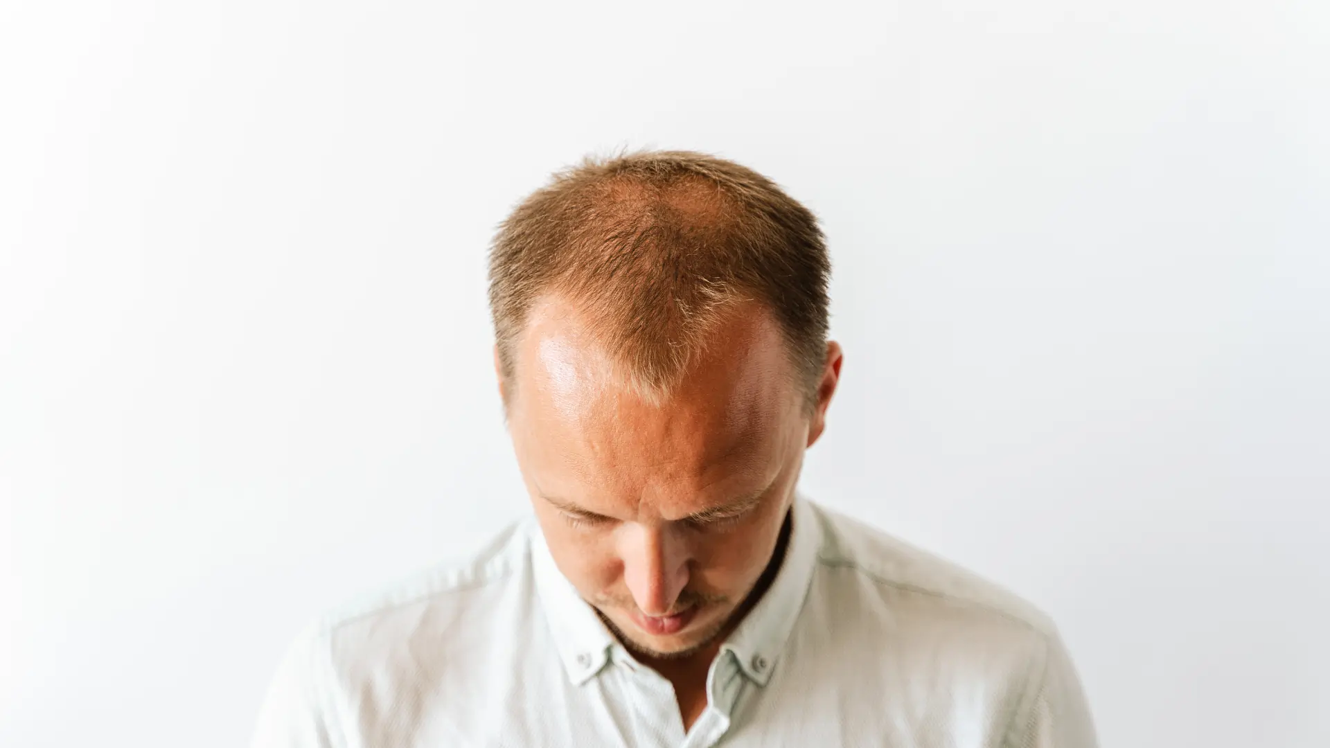 Hair Transplant Recovery Timeline