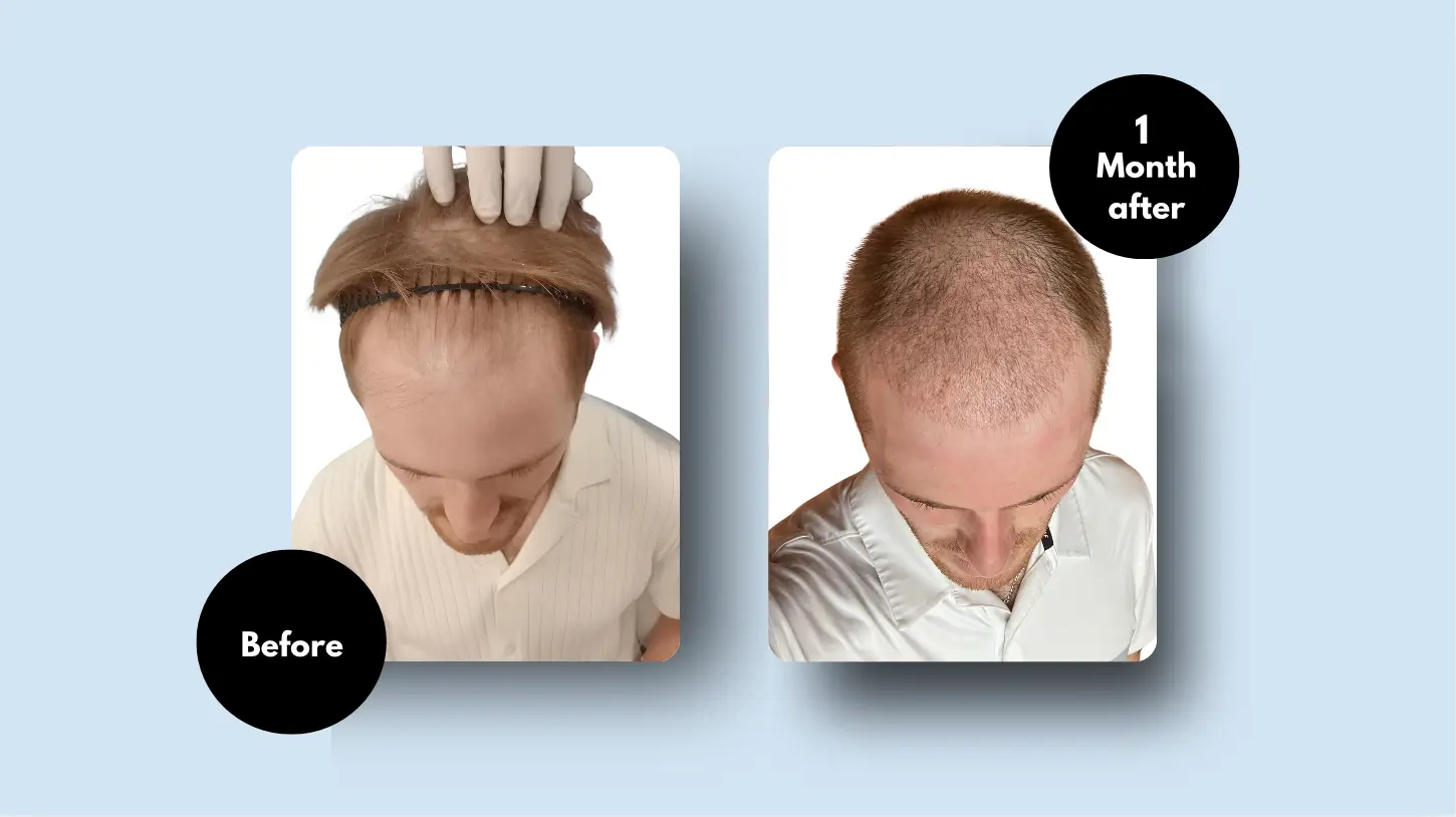 Hair Transplant Results After 1 Month