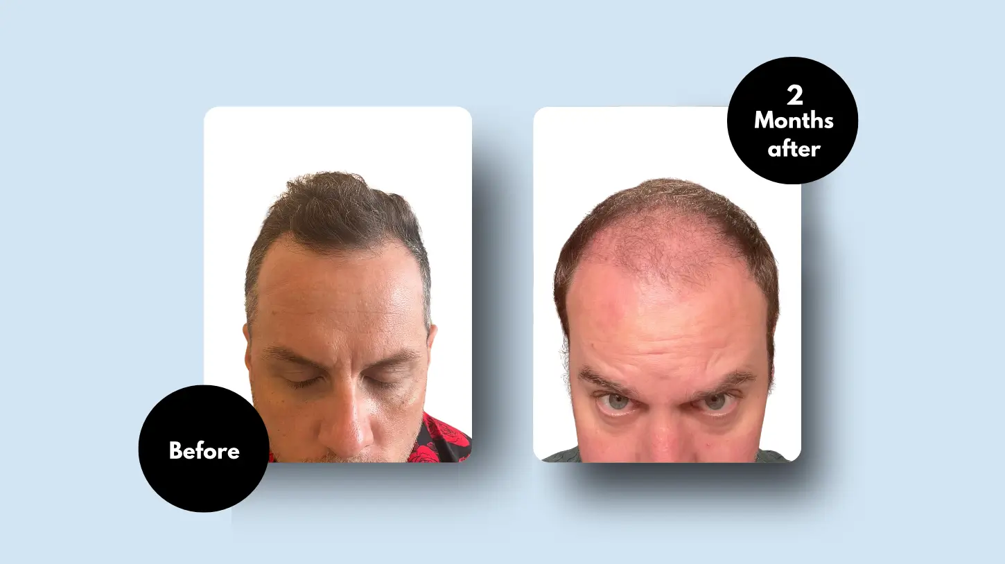 Hair Transplant Results After 2 Months
