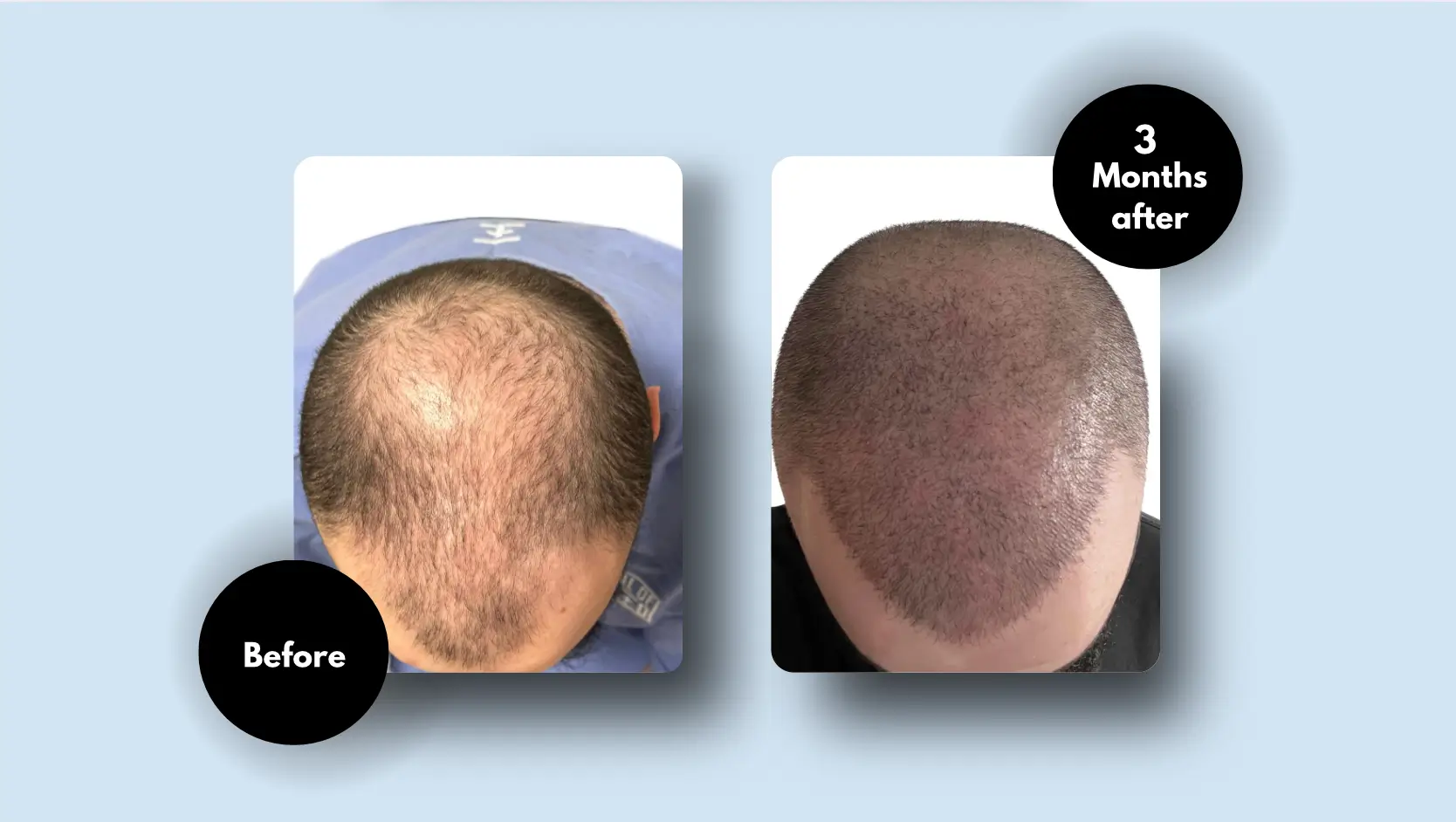 Hair Transplant Results After 3 Months