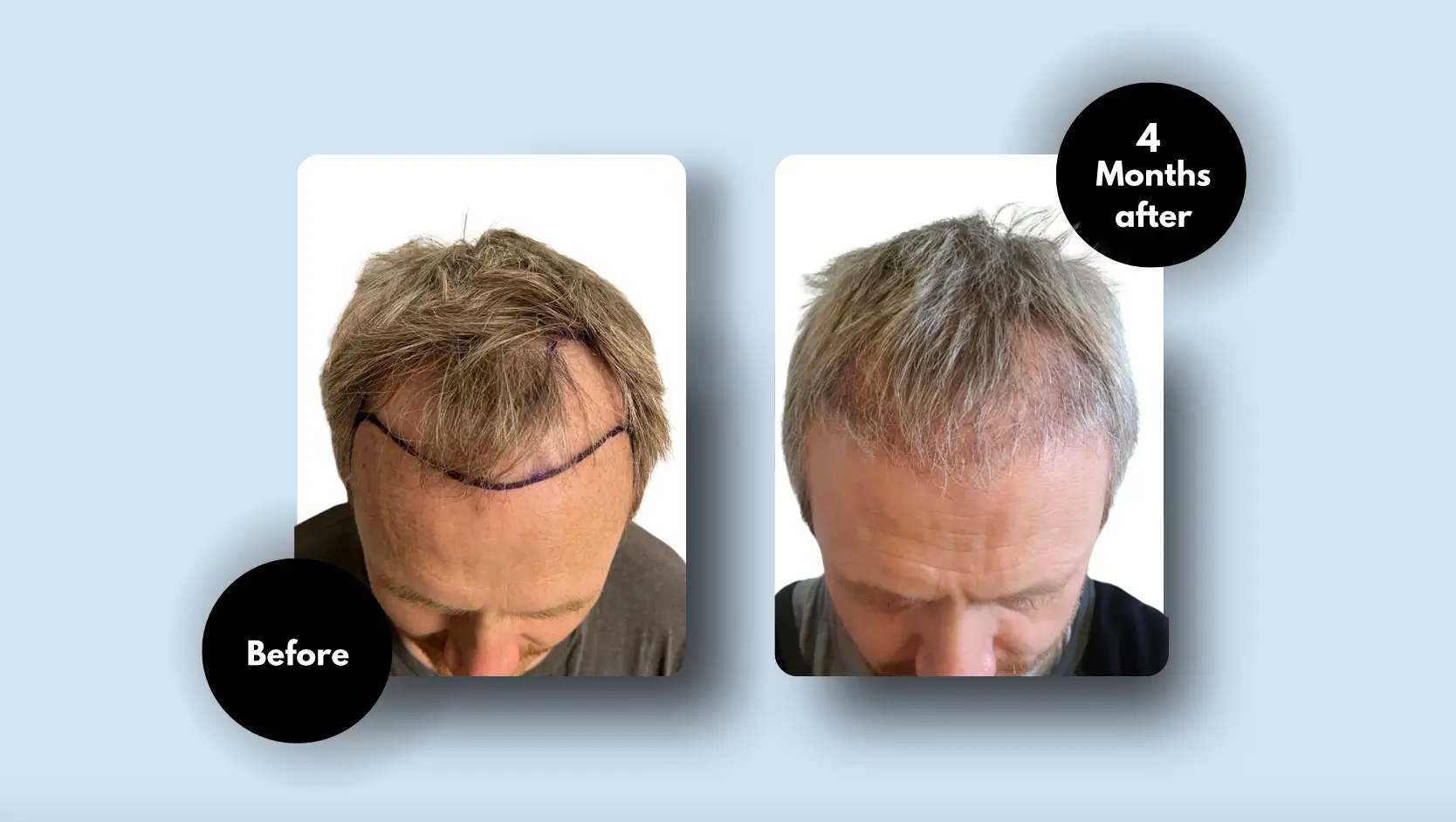 Hair Transplant Results After 4 Months