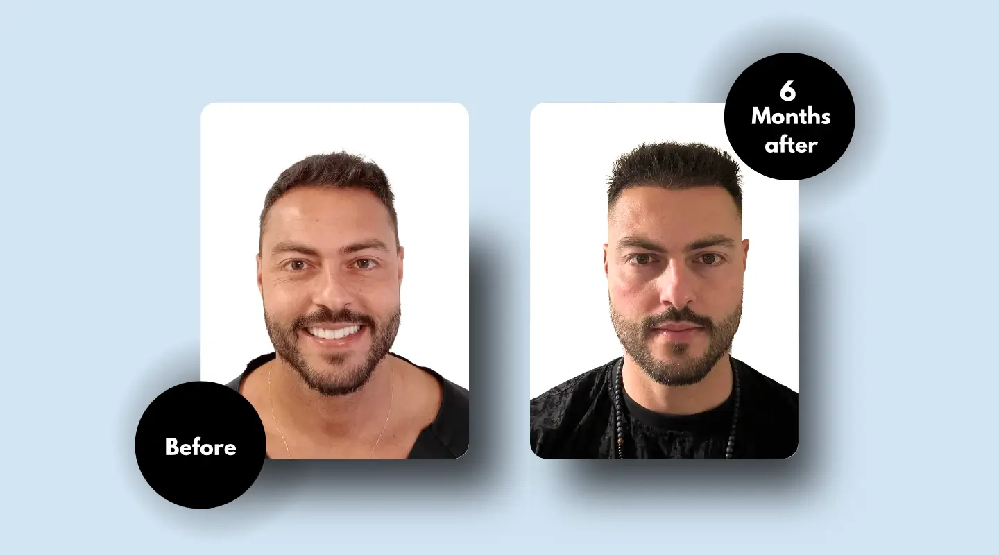 Hair Transplant Results After 6 Months