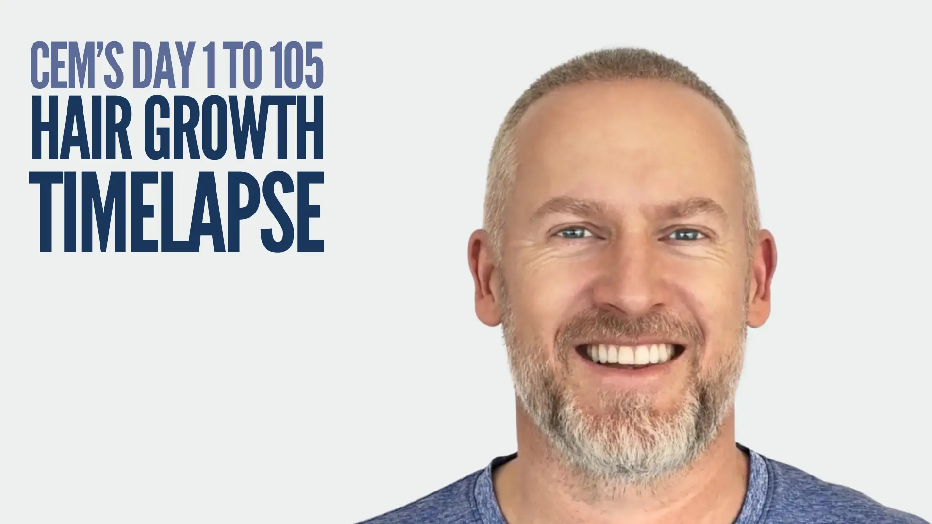 Hair Transplant Timelapse Cem's 1 to 105 Journey
