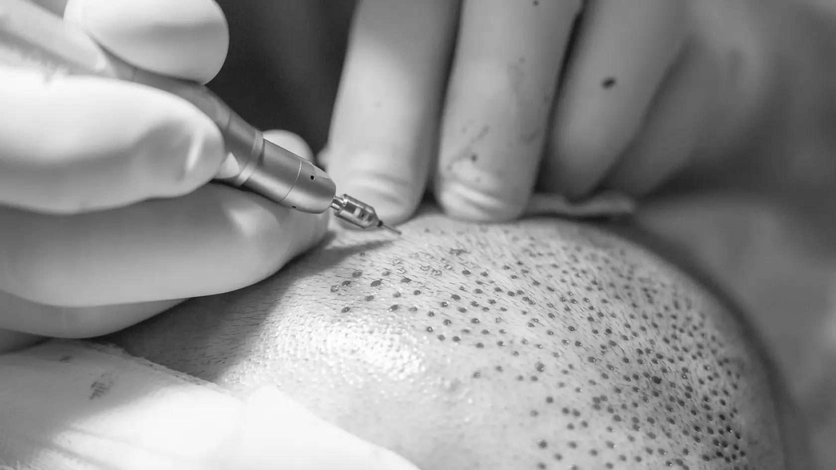Hair Transplant Trypophobia