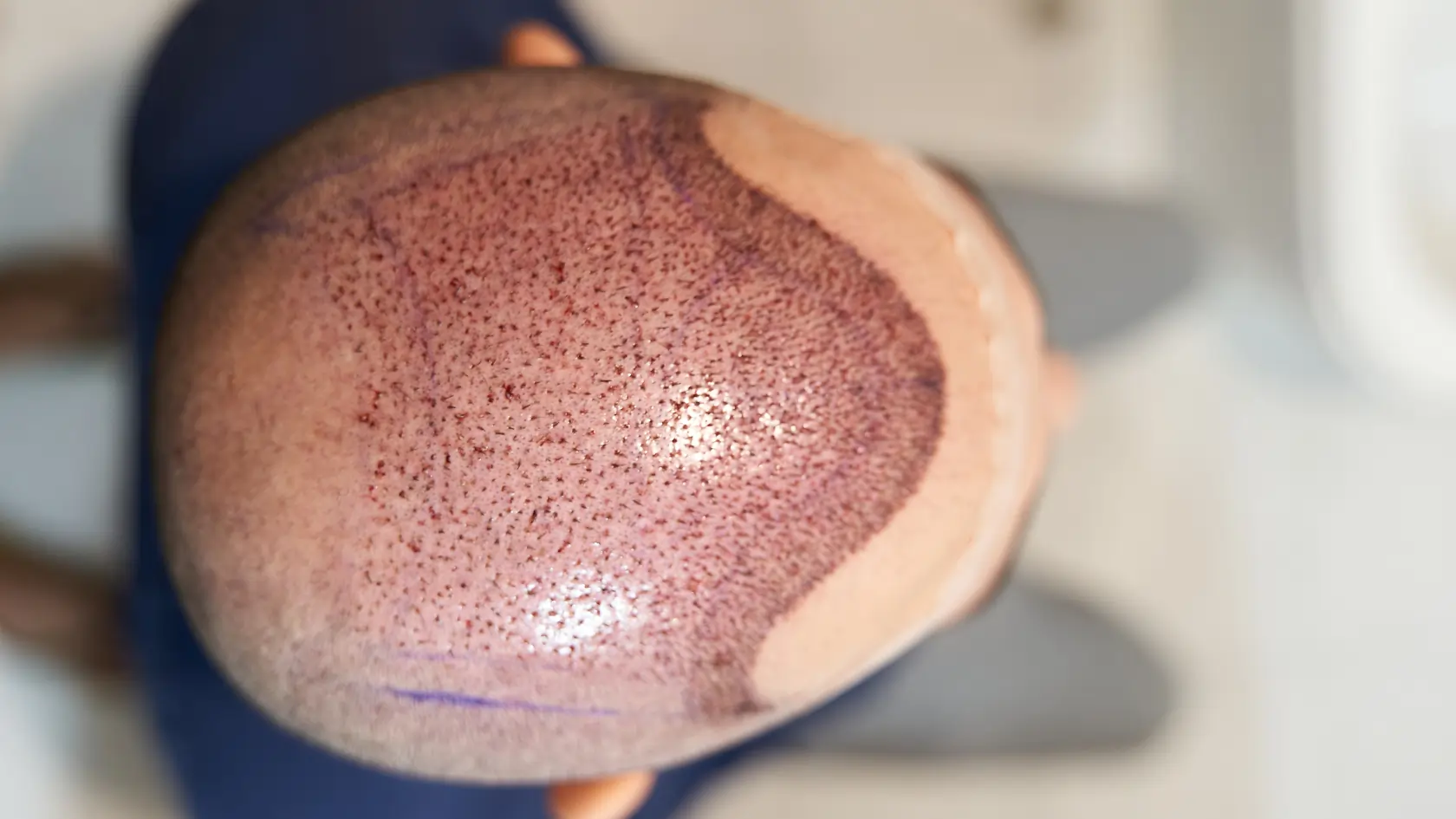 What is Trypophobia? Hair Transplant and Trypophobia FUE FUT Hair Transplantation