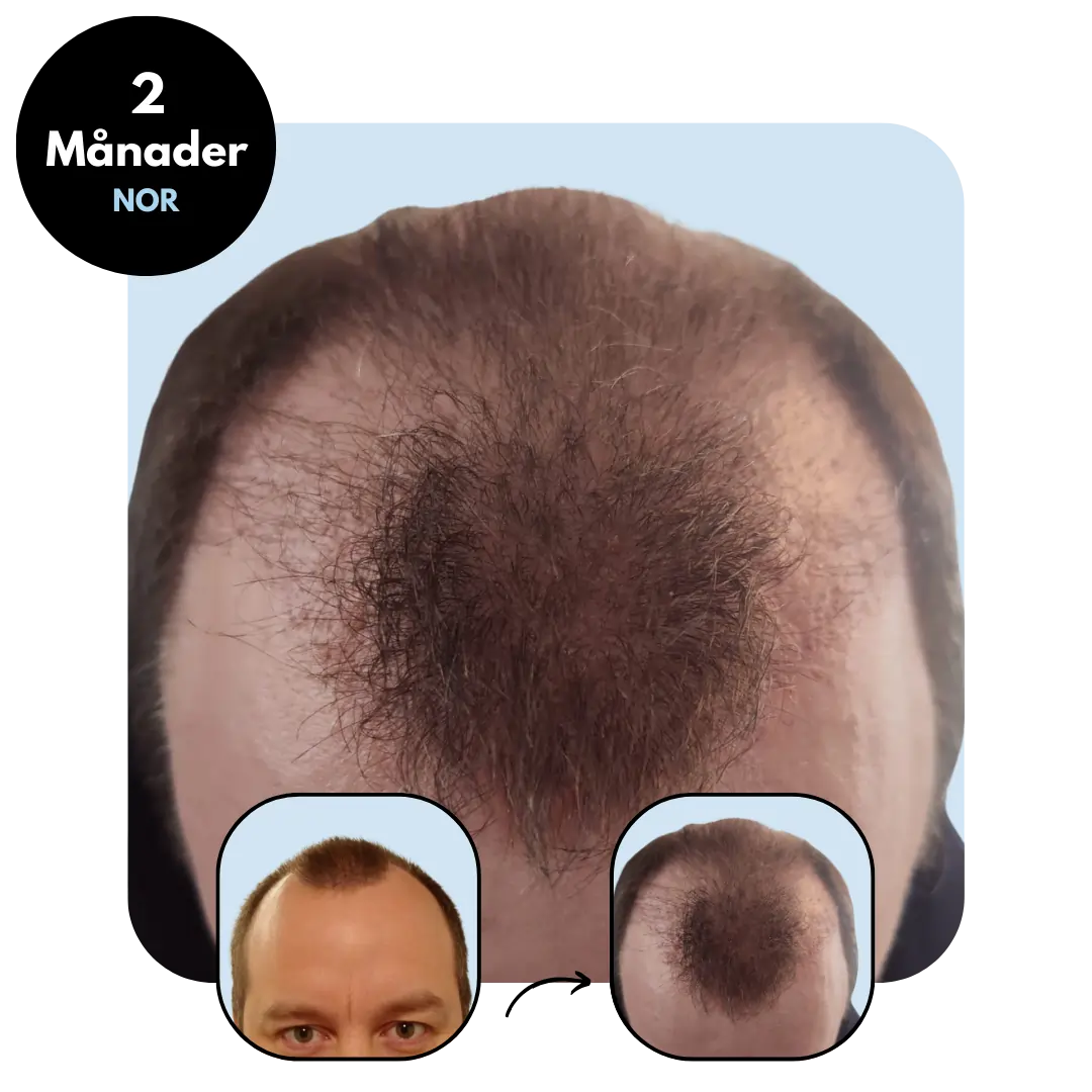 Hårtransplantation resultat efter 2 månader