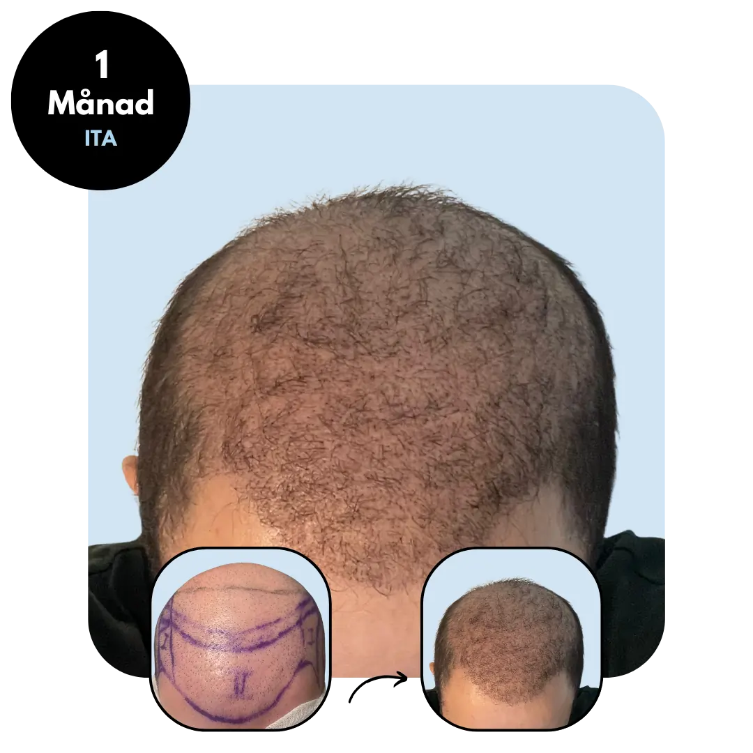 Hårtransplantation resultat efter en månad