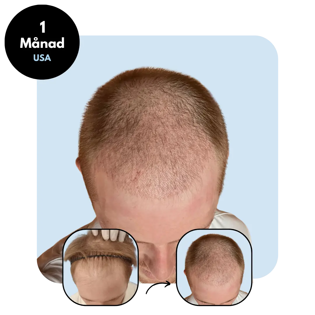Hårtransplantation resultat en månad