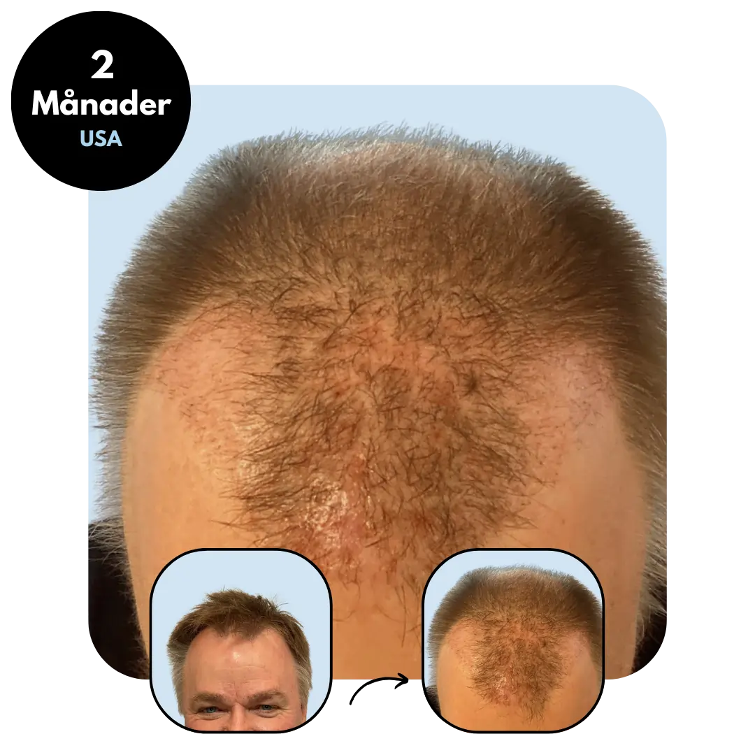 Hårtransplantation t efter 2 månader