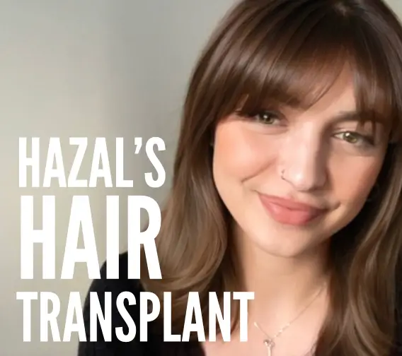 Hazal Hair Transplant Female Hair loss