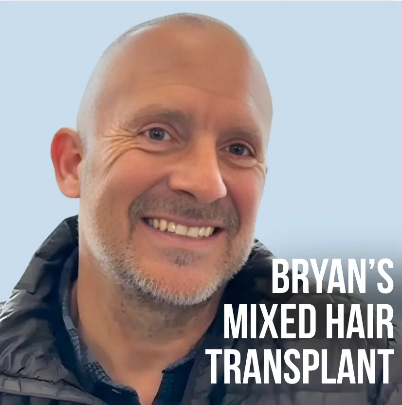 Ideal of MeD Bryan Raydon Mixed Hair Transplant Testimonial