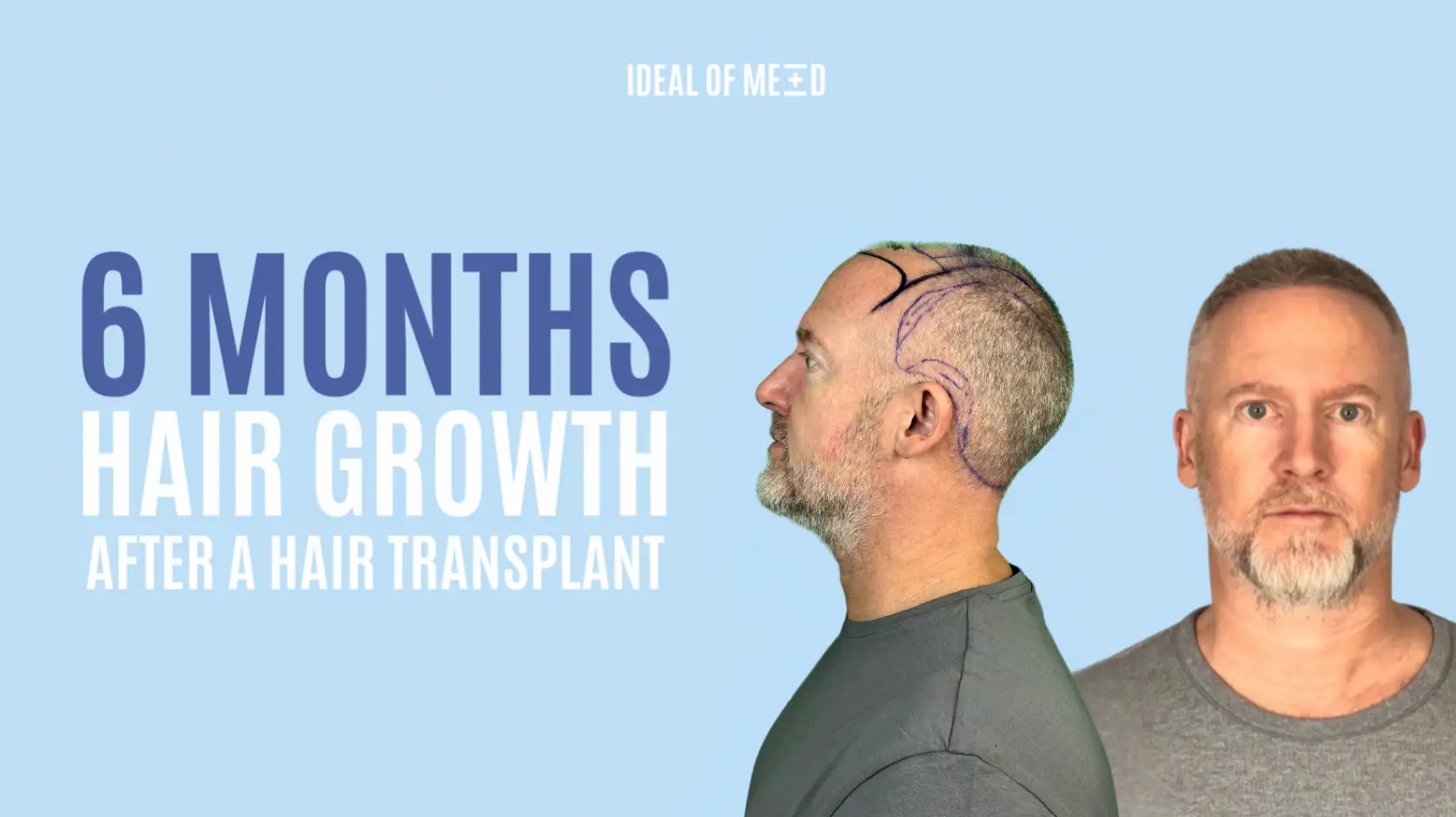 Hair transplant Results after 6 months timelapse