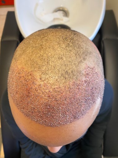 Immediately-after-hair-transplant