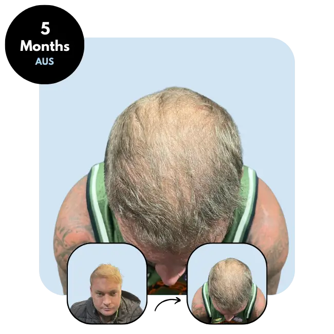 K.L. (33) from Australia hair transplant after 5 months (4800 grafts DHI) at Ideal of MeD