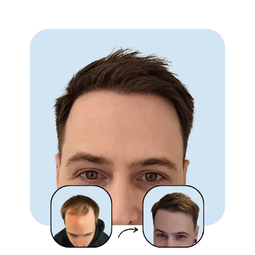 K. S. post hair transplant. Before and after 1 year.