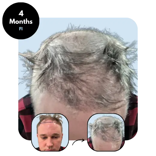 K.S. (38) from Finland after hair transplant month 4