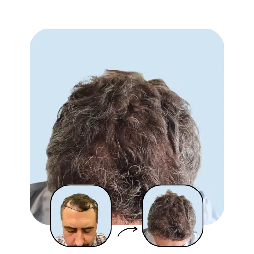 L. M 1 year after hair transplant