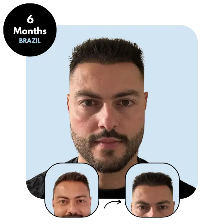 L. S - BR 33yo MIX (3150 grafts) - 6 months after hair transplant