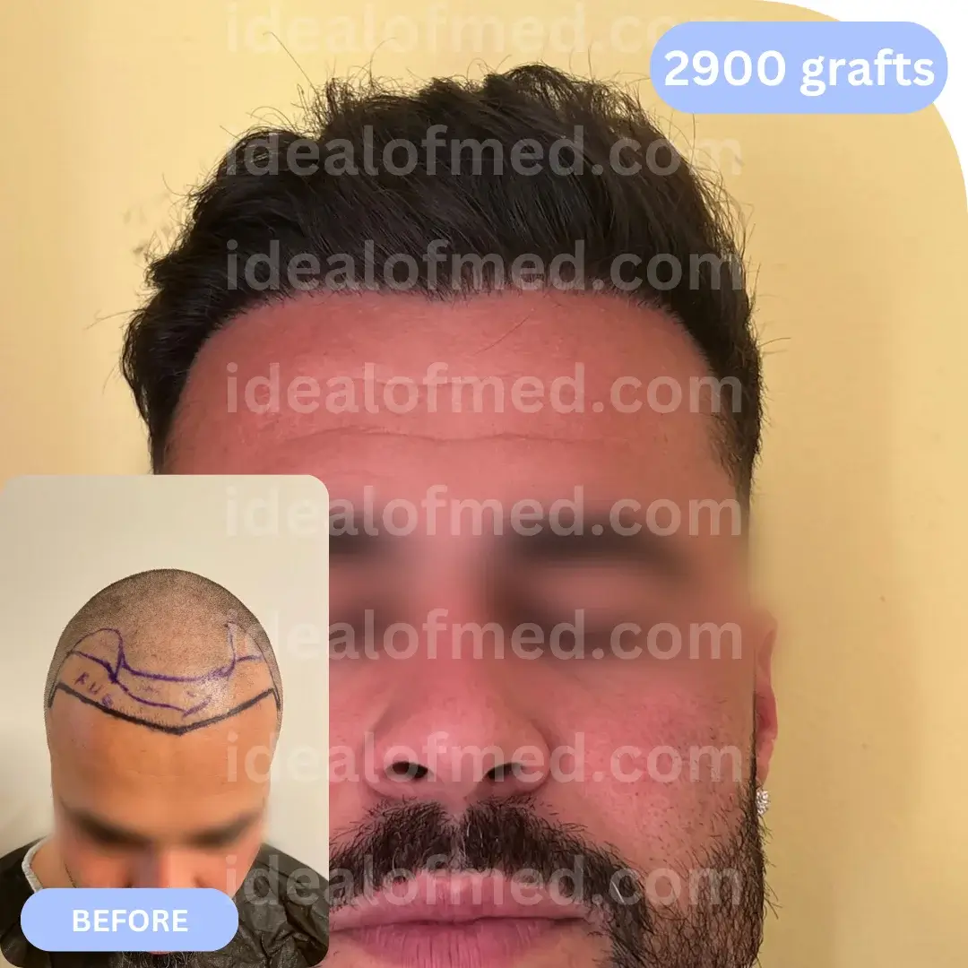 L.G. (43) from Ireland after hair transplant 12 months (Mix 2900 grafts)