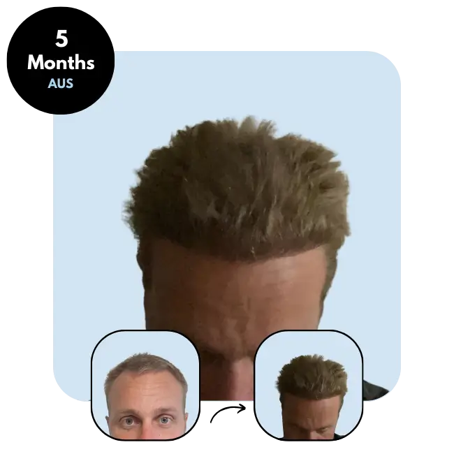 M.G. (35) from Australia hair transplantation after 5 months (3900 grafts Mix)