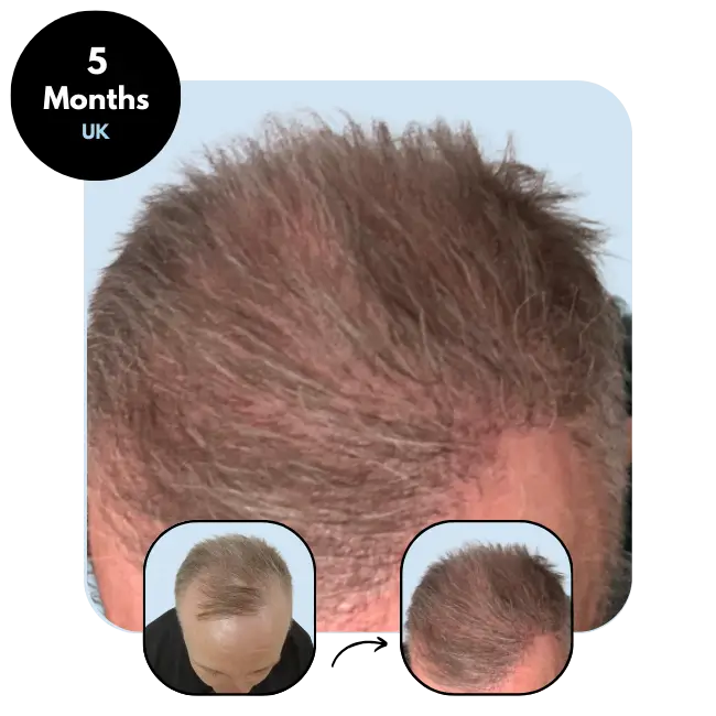 M.H. (57) from United Kingdom hair transplant after 5 months (4600 grafts Mix)