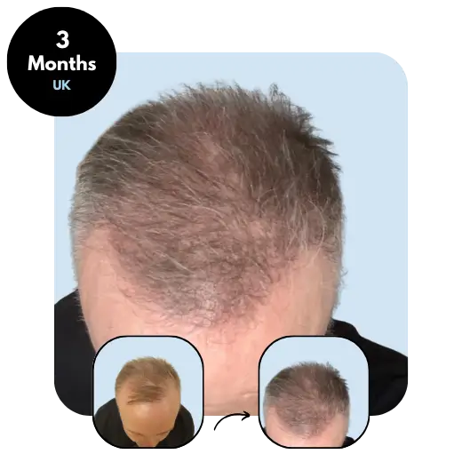 M. H. (57) from UK 3 months after hair transplant
