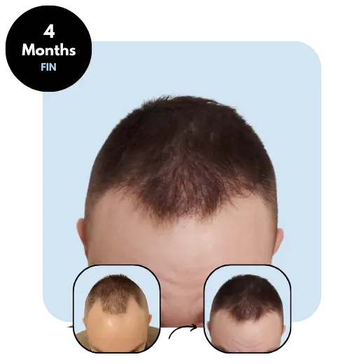 M.E. (26) from Finland after hair transplant month 4