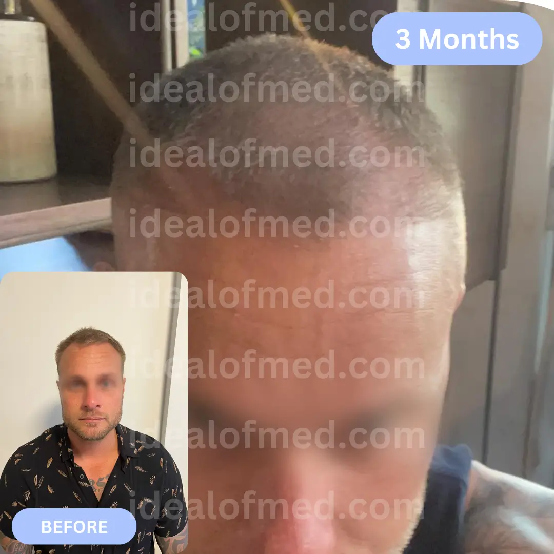 M.G. (35) from Australia hair transplantation after 3 months (3900 grafts Mix)