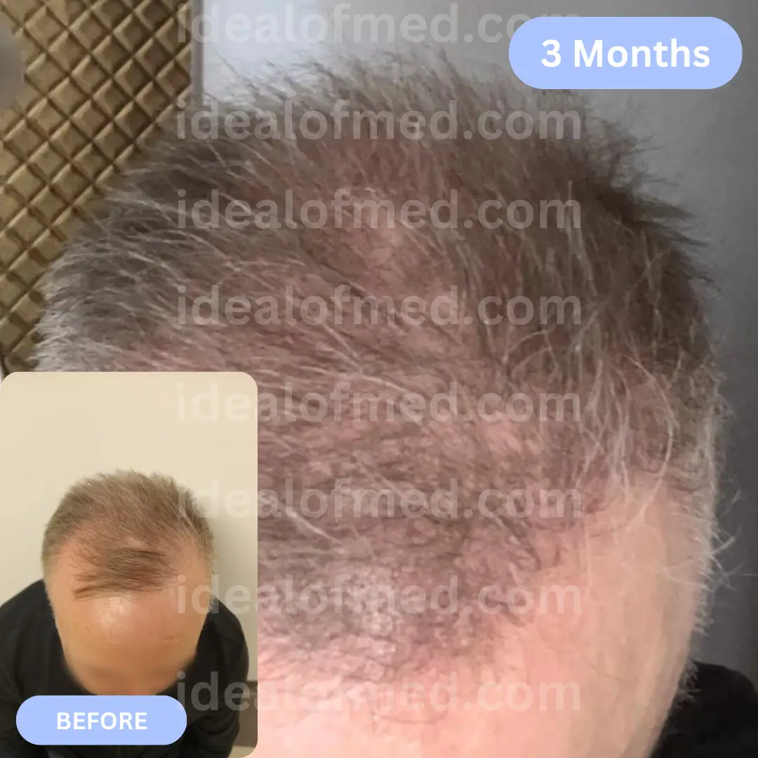 M.H. (57) from United Kingdom hair transplant after 3 months (4600 grafts Mix)