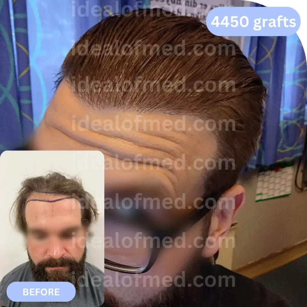 N.S. (36) from Norway after hair transplant 12 months (Mix 4450 grafts)